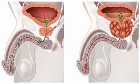 healthy and inflamed prostate with prostatitestat