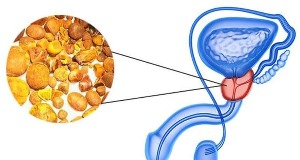 types of prostatitis