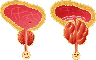 Normal prostate and painful