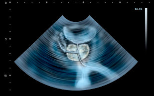 Symptoms of prostatitis ULTRASOUND