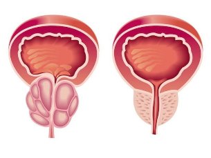 What it looks like prostatitis